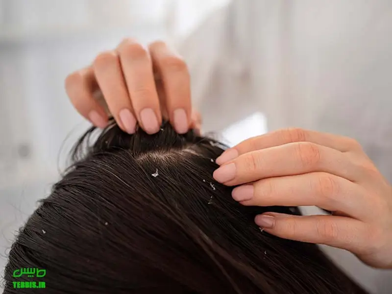 راهکارهای رفع چربی سر در طب سنتی