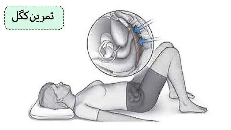 تمرین ورزش کگل