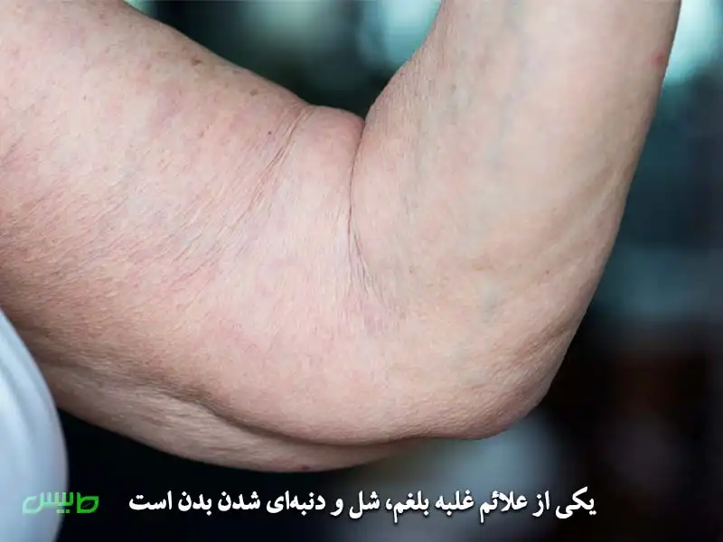 شل و دنبهای شدن بدن بر اثر غلبه بلغم
